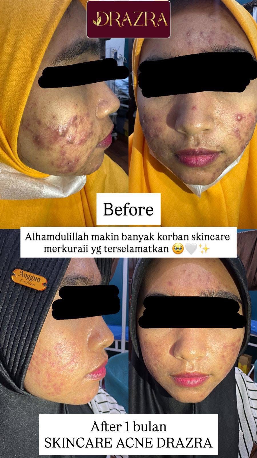 Testimoni before after skincare acne DRAZRA