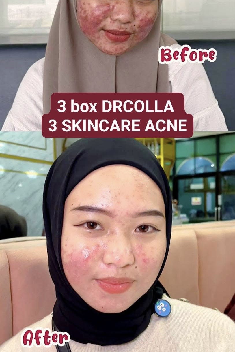 Dokumentasi testimoni pelanggan DRCOLLA dan Acne Series