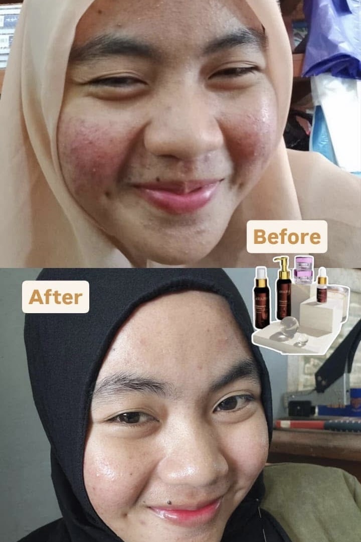 Dokumentasi testimoni before dan after skincare DRAZRA